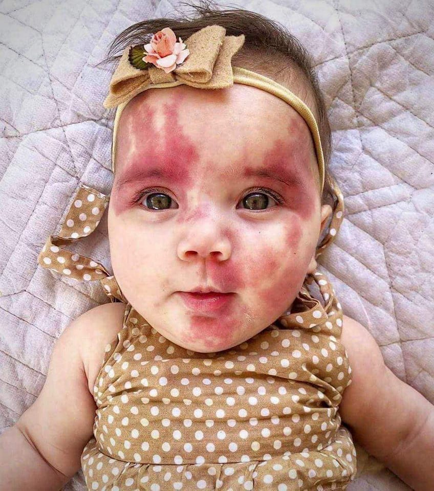 She Was Mocked for Her Face as a Baby But Now She Looks Totally Unrecognizable… Photos Here!