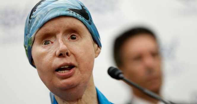 The sad story of Charla Nash, the woman whose face was ripped off by an chimpanzee 