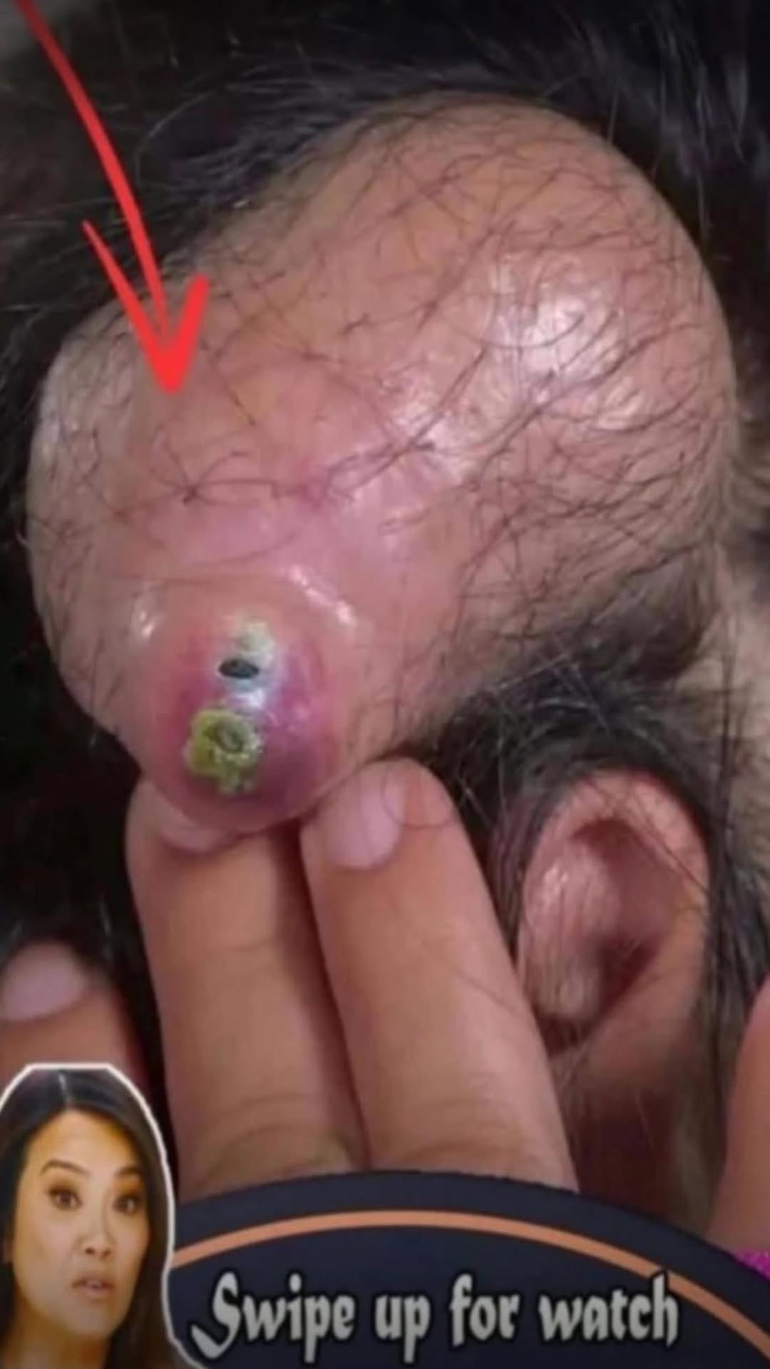 Body Acne: 4 Tips To Get Rid Of Them