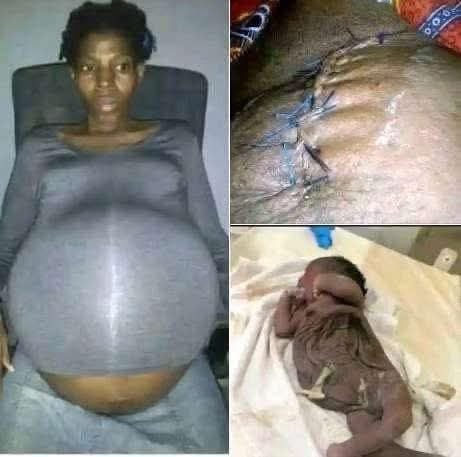 A 30-year-old woman in Georgia was declared brain dead