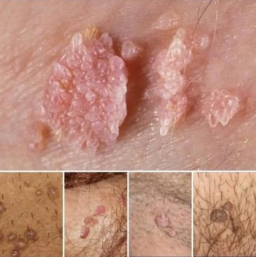 Everything You Need to Know About Genital Herpes.