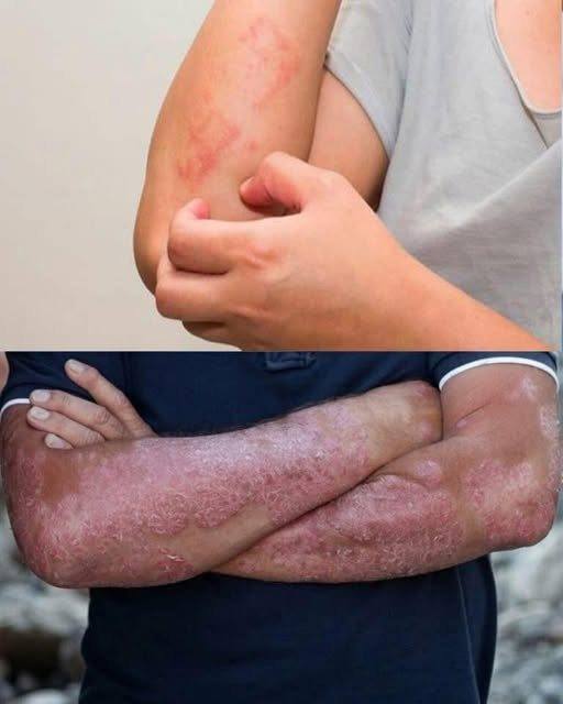 The 7 signs that may indicate psoriasis; the disease has no cure and affects millions