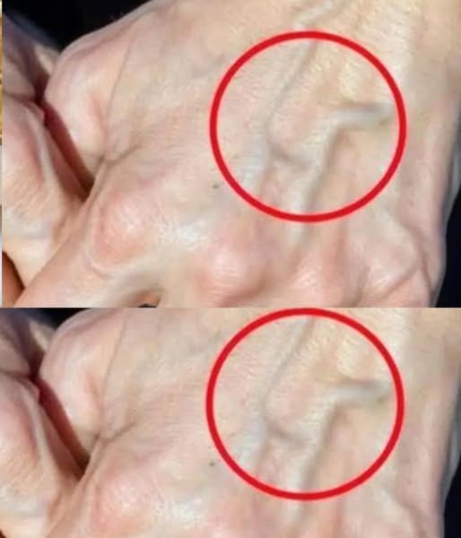Have you ever looked down and noticed veins on your hands, arms, legs, or even chest that seem to have appeared out of nowhere?