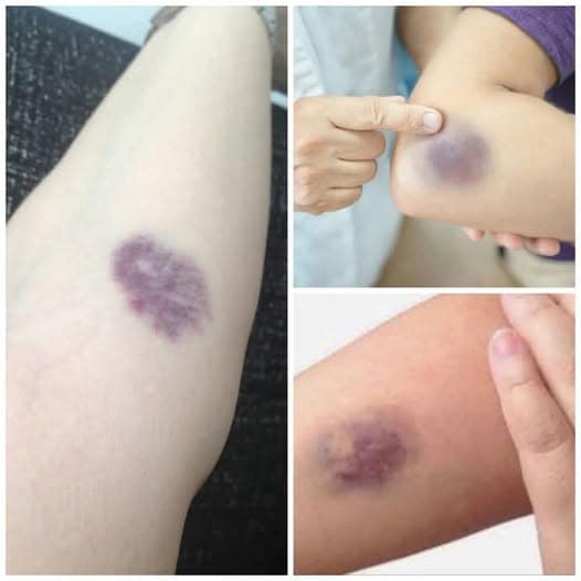 When to Pay Attention to Unusual Bruises on Your Body