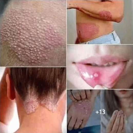 Signs of Human Papillomavirus (HPV) You Shouldn’t Ignore