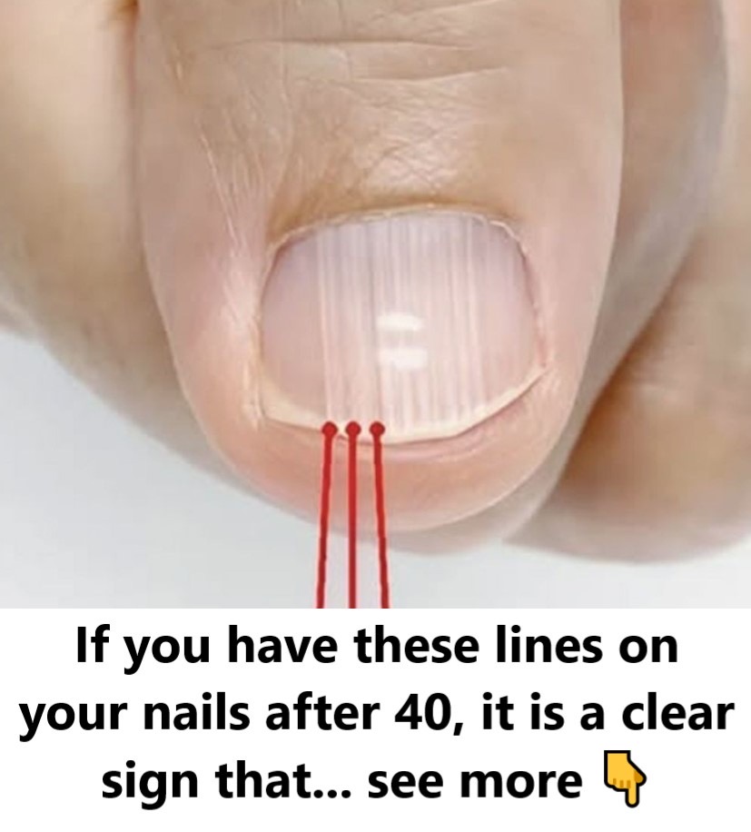 When you see these ridges on your nails after age 40, it’s an obvious warning – The Concealed Messages Behind Nail Appearances