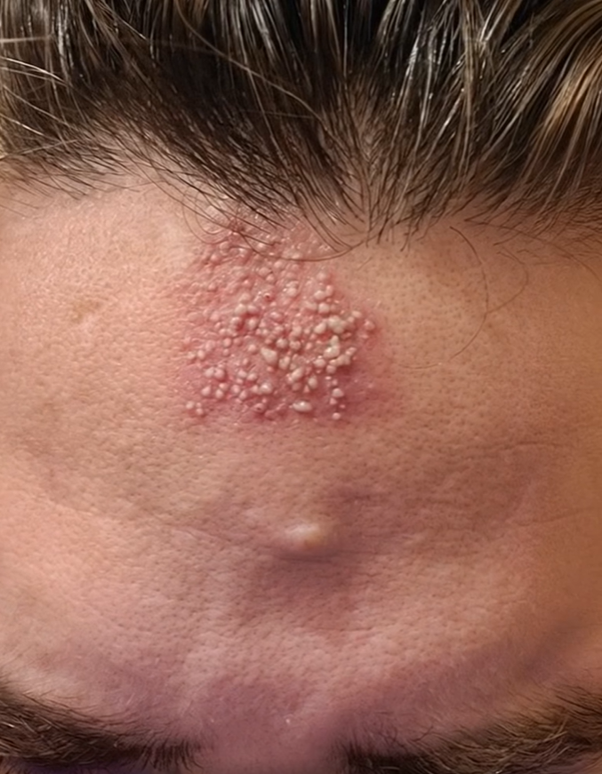 How Leaving Makeup on Overnight Impacts Your Skin Health